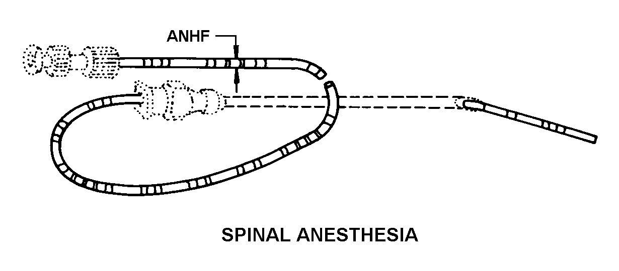 SPINAL ANESTHESIA style nsn 6515-00-302-5225