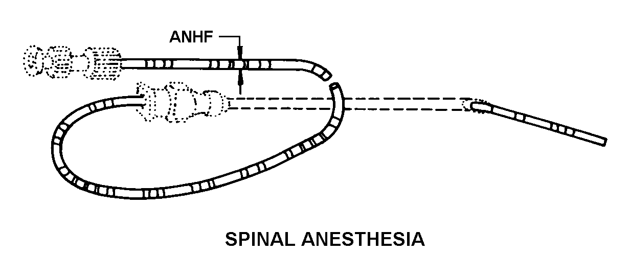 SPINAL ANESTHESIA style nsn 6515-01-528-1212